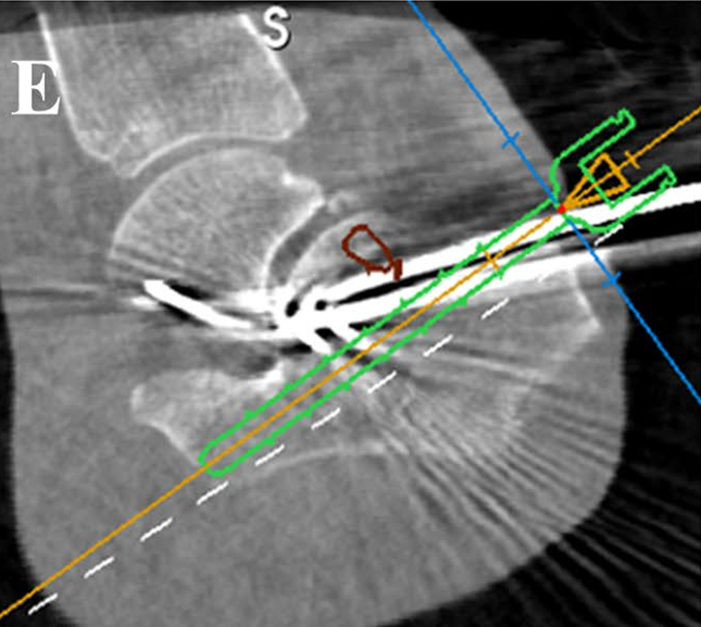 Fig. 2E